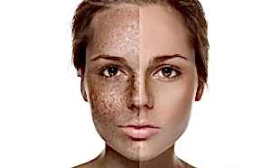 Ameliyatsız Ben Aldırma Tedavisi